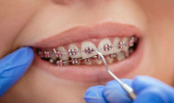 How Orthodontic Care Enhances Confidence And Everyday Smiles